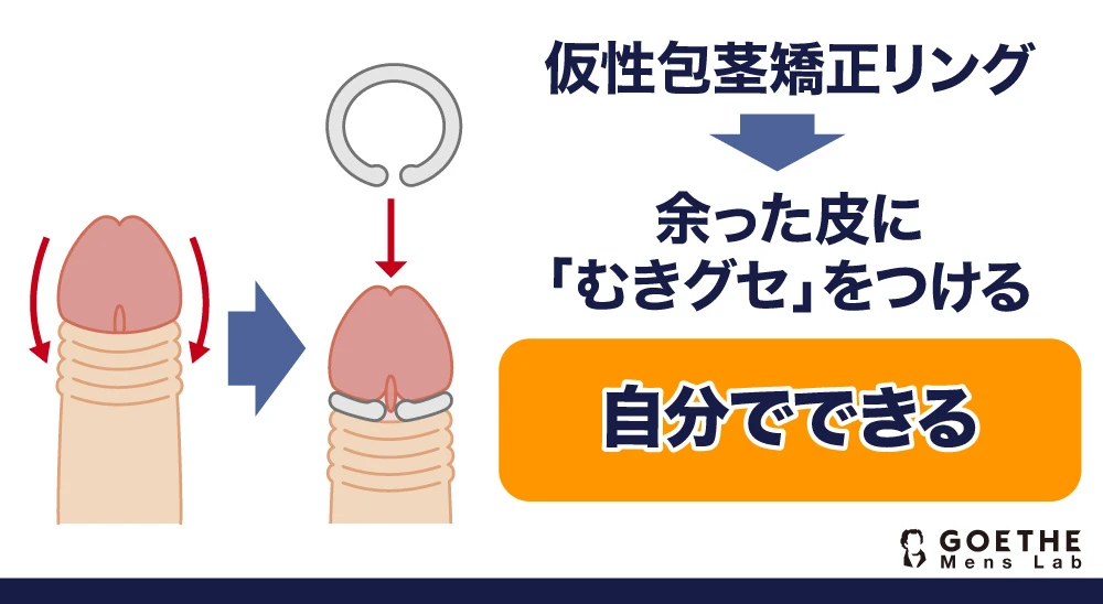 仮性包茎矯正リング→余った皮に「むきグセ」をつける【自分でできる】