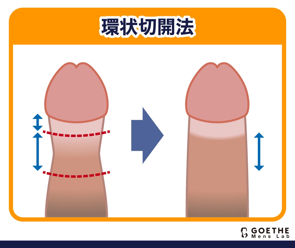 環状切開法