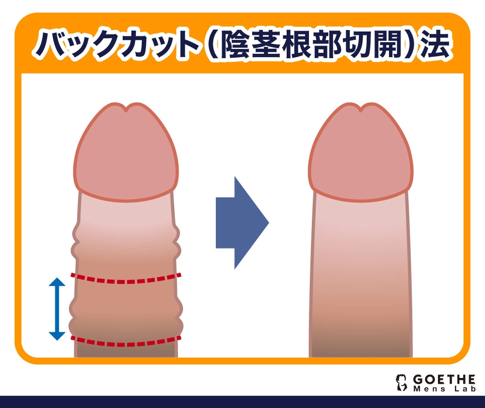 バックカット（陰茎根部切開）法