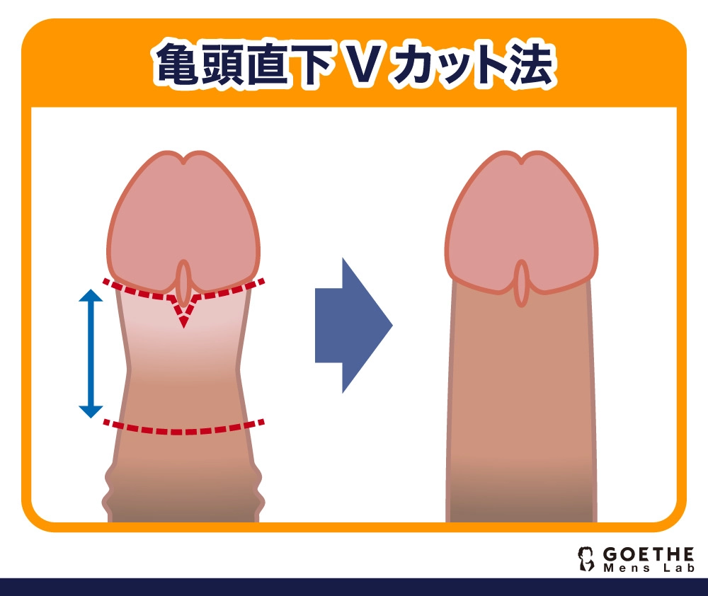 亀頭直下Vカット法