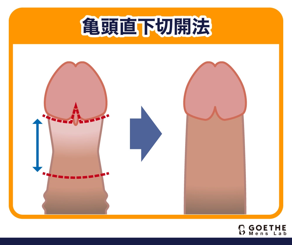 亀頭直下切開法