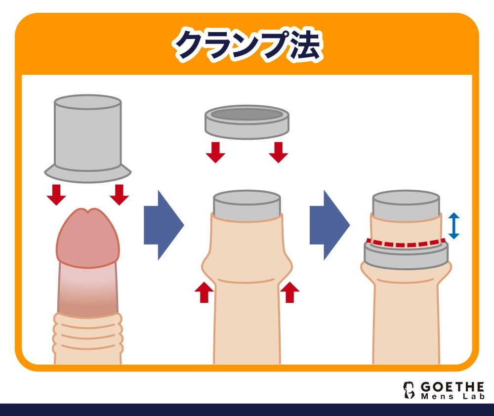 クランプ法