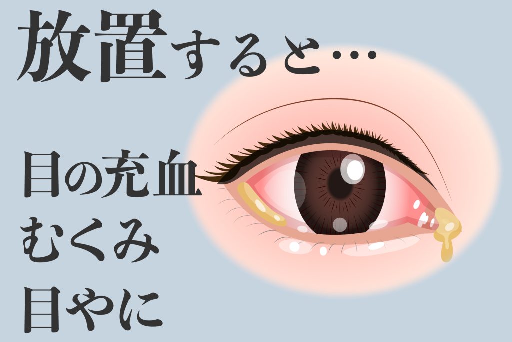 クラミジアが目に感染すると充血やむくみ、目やになどの症状が出る